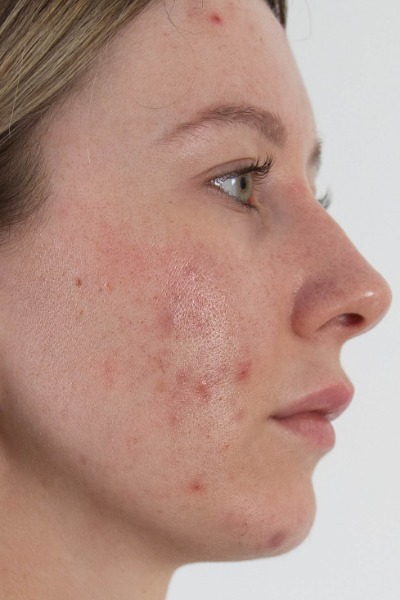 Before Fotopeel